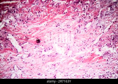 Histopathologie der tuberkulösen Pleuritis, Lichtmikrographen, Lichtbild unter dem Mikroskop Stockfoto