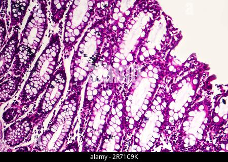 Bakterielle Dysenterie, Lichtmikroskopie, Foto unter dem Mikroskop, das das Vorhandensein von Bakterien und die Ansammlung von Entzündungszellen zeigt Stockfoto