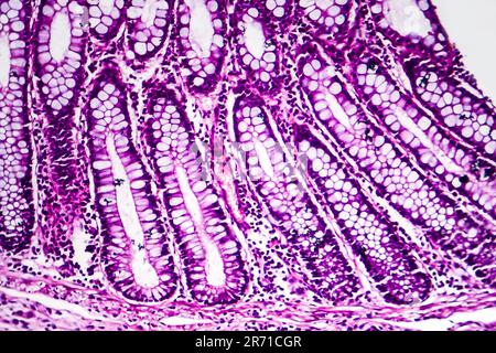 Bakterielle Dysenterie, Lichtmikroskopie, Foto unter dem Mikroskop, das das Vorhandensein von Bakterien und die Ansammlung von Entzündungszellen zeigt Stockfoto