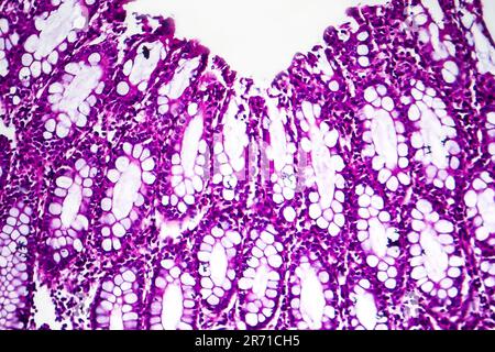 Bakterielle Dysenterie, Lichtmikroskopie, Foto unter dem Mikroskop, das das Vorhandensein von Bakterien und die Ansammlung von Entzündungszellen zeigt Stockfoto