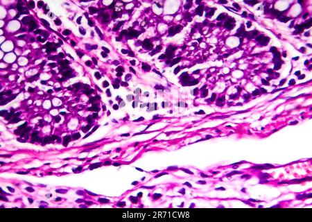 Bakterielle Dysenterie, Lichtmikroskopie, Foto unter dem Mikroskop, das das Vorhandensein von Bakterien und die Ansammlung von Entzündungszellen zeigt Stockfoto