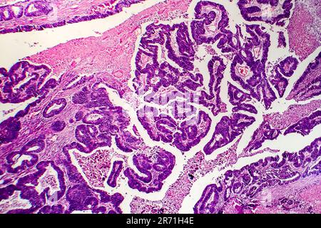 Differenziertes intestinales Adenokarzinom, Lichtmikrogramm, Foto unter dem Mikroskop Stockfoto