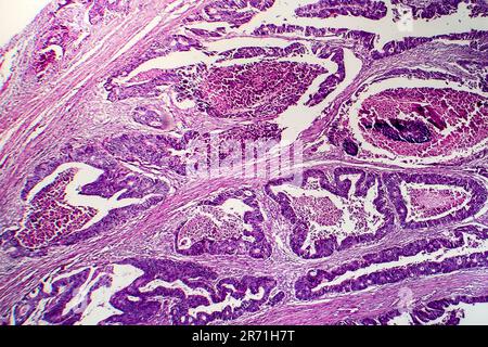 Differenziertes intestinales Adenokarzinom, Lichtmikrogramm, Foto unter dem Mikroskop Stockfoto