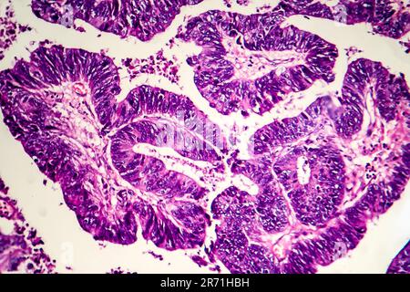 Differenziertes intestinales Adenokarzinom, Lichtmikrogramm, Foto unter dem Mikroskop Stockfoto