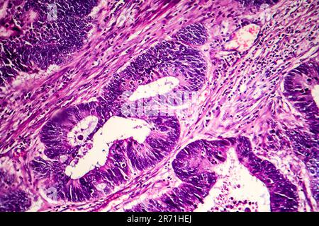 Differenziertes intestinales Adenokarzinom, Lichtmikrogramm, Foto unter dem Mikroskop Stockfoto