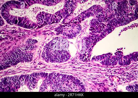 Differenziertes intestinales Adenokarzinom, Lichtmikrogramm, Foto unter dem Mikroskop Stockfoto