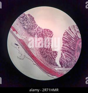 Bakterielle Dysenterie, Lichtmikroskopie, Foto unter dem Mikroskop, das das Vorhandensein von Bakterien und die Ansammlung von Entzündungszellen im Darmepithe zeigt Stockfoto