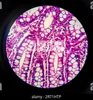 Bakterielle Dysenterie, Lichtmikroskopie, Foto unter dem Mikroskop, das das Vorhandensein von Bakterien und die Ansammlung von Entzündungszellen im Darmepithe zeigt Stockfoto