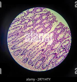 Bakterielle Dysenterie, Lichtmikroskopie, Foto unter dem Mikroskop, das das Vorhandensein von Bakterien und die Ansammlung von Entzündungszellen im Darmepithe zeigt Stockfoto