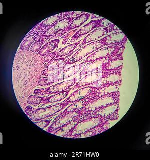 Bakterielle Dysenterie, Lichtmikroskopie, Foto unter dem Mikroskop, das das Vorhandensein von Bakterien und die Ansammlung von Entzündungszellen im Darmepithe zeigt Stockfoto