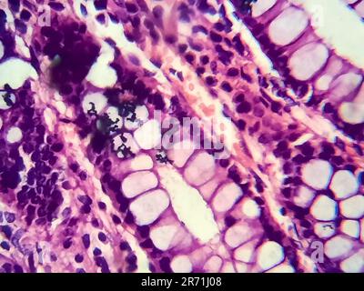 Bakterielle Dysenterie, Lichtmikroskopie, Foto unter dem Mikroskop, das das Vorhandensein von Bakterien und die Ansammlung von Entzündungszellen im Darmepithe zeigt Stockfoto