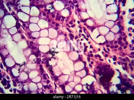 Bakterielle Dysenterie, Lichtmikroskopie, Foto unter dem Mikroskop, das das Vorhandensein von Bakterien und die Ansammlung von Entzündungszellen im Darmepithe zeigt Stockfoto