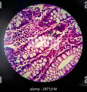 Bakterielle Dysenterie, Lichtmikroskopie, Foto unter dem Mikroskop, das das Vorhandensein von Bakterien und die Ansammlung von Entzündungszellen im Darmepithe zeigt Stockfoto