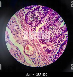 Bakterielle Dysenterie, Lichtmikroskopie, Foto unter dem Mikroskop, das das Vorhandensein von Bakterien und die Ansammlung von Entzündungszellen im Darmepithe zeigt Stockfoto