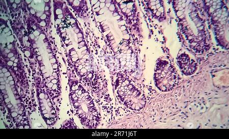 Bakterielle Dysenterie, Lichtmikroskopie, Foto unter dem Mikroskop, das das Vorhandensein von Bakterien und die Ansammlung von Entzündungszellen im Darmepithe zeigt Stockfoto