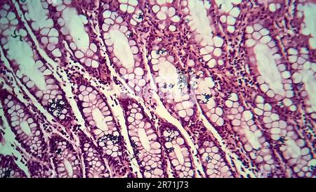 Bakterielle Dysenterie, Lichtmikroskopie, Foto unter dem Mikroskop, das das Vorhandensein von Bakterien und die Ansammlung von Entzündungszellen im Darmepithe zeigt Stockfoto