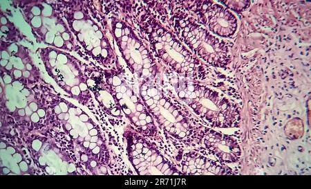 Bakterielle Dysenterie, Lichtmikroskopie, Foto unter dem Mikroskop, das das Vorhandensein von Bakterien und die Ansammlung von Entzündungszellen im Darmepithe zeigt Stockfoto