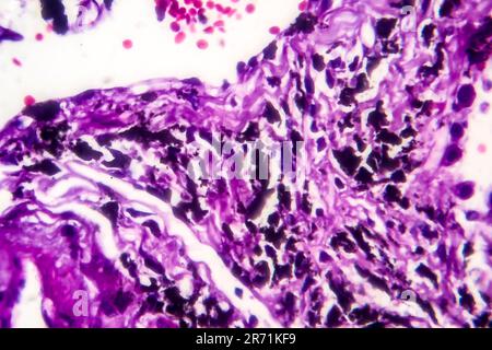 Histopathologie der Raucherlunge. Lichtmikrographie zeigt Akkumulation von Kohlenstoffpartikeln im Lungengewebe Stockfoto
