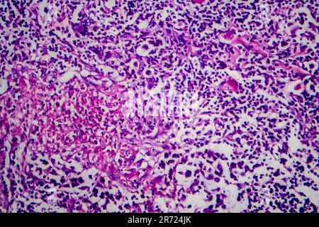 Hodgkin-Lymphom, Lichtmikroskop, Foto unter dem Mikroskop Stockfoto