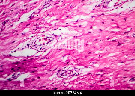 Hodgkin-Lymphom, Lichtmikroskop, Foto unter dem Mikroskop Stockfoto