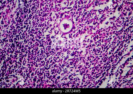 Hodgkin-Lymphom, Lichtmikroskop, Foto unter dem Mikroskop Stockfoto