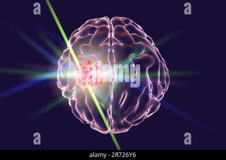 Konzeptionelles Bild zur Hirnkrebsbehandlung. Computerabbildung zeigt Zerstörung eines Hirntumors. Stockfoto