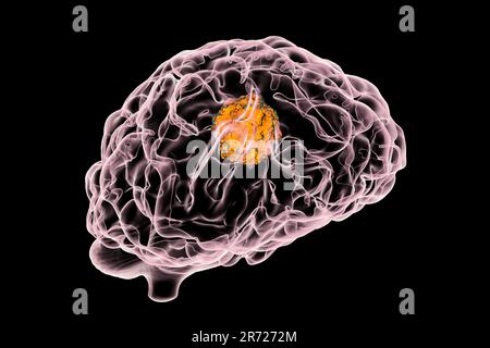 Hirntumor, Computer-Grafik. Stockfoto