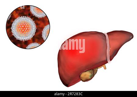 Leber mit Hepatitis und Nahaufnahme Blick auf Hepatitis C-Viren, Abbildung. Stockfoto