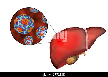 Leber mit Hepatitis und Nahaufnahme von Hepatitis-A-Viren, Illustration. Hepatitis A wird durch infizierte Nahrungsmittel oder Getränke übertragen. Symptome einschl Stockfoto