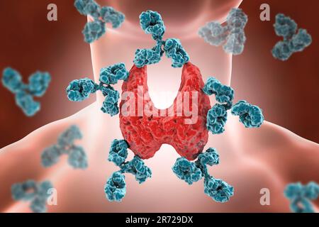 Autoimmunthyreoiditis (Morbus Hashimoto), konzeptionelles Bild. Abbildung zeigt Antikörper, die die Schilddrüse angreifen. Stockfoto