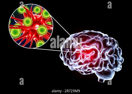 Virale Enzephalitis. Konzeptionelles Bild zeigt Gehirn und Nahaufnahme von Viren, die Neuronen infizieren. Stockfoto