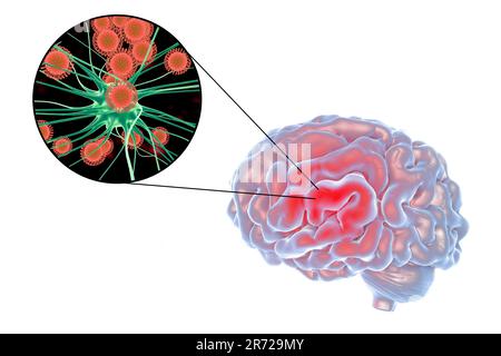 Virale Enzephalitis. Konzeptionelles Bild zeigt Gehirn und Nahaufnahme von Viren, die Neuronen infizieren. Stockfoto