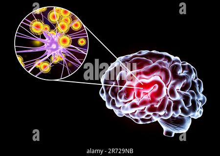 Virale Enzephalitis. Konzeptionelles Bild zeigt Gehirn und Nahaufnahme von Viren, die Neuronen infizieren. Stockfoto