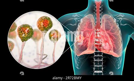 Lungenmukormykose (oder Jochmykose), eine Lungenerkrankung, verursacht durch Pilze Mucor, auch bekannt als schwarzer Pilz, mit Nahaufnahme der Pilze, Computer i Stockfoto