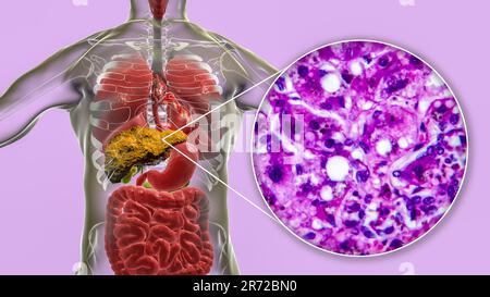 Leberzirrhose, Computerdarstellung und Lichtmikroskopie eines Schnitts durch eine menschliche Leber mit Stockfoto