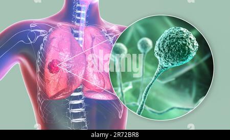 Lungenmukormykose (oder Jochmykose), eine Lungenerkrankung, verursacht durch Pilze Mucor, auch bekannt als schwarzer Pilz, mit Nahaufnahme der Pilze, Computer i Stockfoto