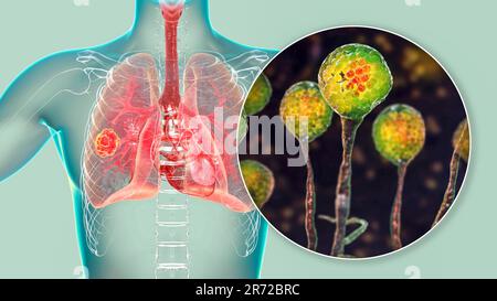 Lungenmukormykose (oder Jochmykose), eine Lungenerkrankung, verursacht durch Pilze Mucor, auch bekannt als schwarzer Pilz, mit Nahaufnahme der Pilze, Computer i Stockfoto