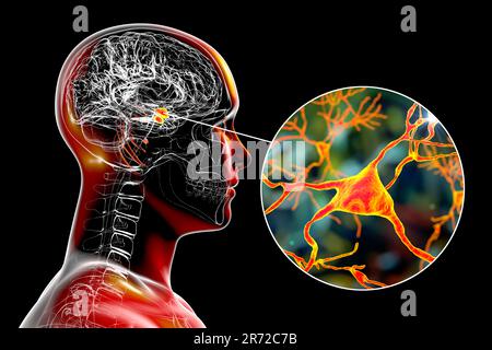 Amygdala im Gehirn und Nahaufnahme von Amygdala-Neuronen, Computerdarstellung. Zwei mandelförmige Kerne in Temporallappen, Teil o Stockfoto