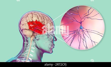 Menschliches Gehirn mit hervorgehobener Temporallappen und Nahaufnahme von Neuronen im Temporallappen, Computerdarstellung. Stockfoto