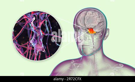 Menschliches Gehirn mit hervorgehobenen pons und Neuronen, Illustration. Menschliches Gehirn mit hervorgehobener pons Varolii und Nahaufnahme von pyramidalen Neuronen (Nerv c Stockfoto