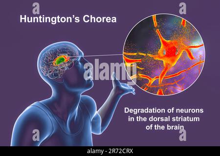 Dorsales Striatum, Nucleus caudatus und Putamen, hervorgehoben im Gehirn einer Person mit Morbus Huntington und Nahaufnahme des neuronalen Abbaus Stockfoto