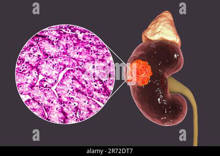 Nierenkrebs, Computerdarstellung und leichte Mikrograph. Stockfoto