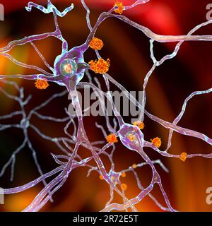 Neuronale Einschlüsse bei Morbus Huntington, Computerdarstellung. Einschlüsse bestehen aus mutiertem Jagdtingtin-Protein, sie werden zunächst A gebildet Stockfoto