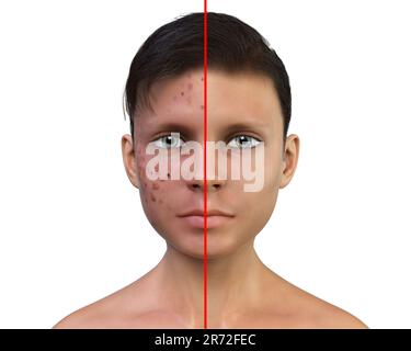 Akne vulgaris im Gesicht eines Jugendlichen Jungen, Computerdarstellung der Haut des Jungen vor und nach der Behandlung. Akne ist ein allgemeiner Name, der einer Haut gegeben wird Stockfoto