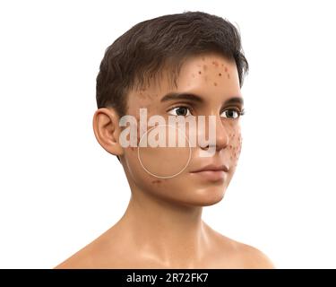 Akne vulgaris im Gesicht eines Jugendlichen Jungen, Computerdarstellung der Haut des Jungen vor und nach der Behandlung. Akne ist ein allgemeiner Name, der einer Haut gegeben wird Stockfoto