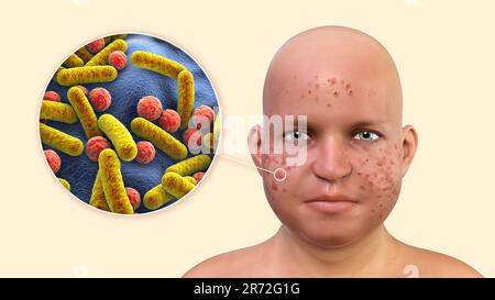 Akne vulgaris im Gesicht eines übergewichtigen Jugendlichen Jungen und Nahaufnahme von Bakterien, die Akne verursachen, Computerdarstellung. Akne ist eine allgemeine Bezeichnung, die t genannt wird Stockfoto