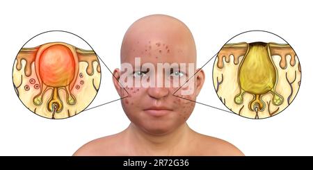 Akne vulgaris auf dem Gesicht eines übergewichtigen Teenagers und Nahaufnahme von schwarz-weißen Komedonen, Computerabbildung. Akne ist ein allgemeiner Name Stockfoto