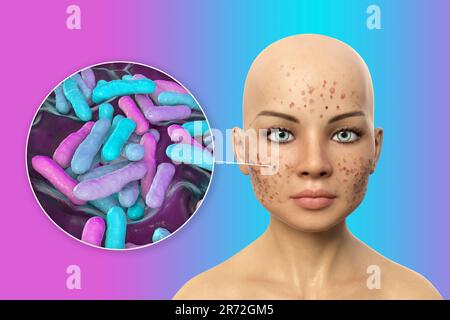 Akne vulgaris im Gesicht eines Teenagers und Nahaufnahme von Bakterien, die Akne verursachen, Computerdarstellung. Akne ist ein allgemeiner Name, der einem Haut-di gegeben wird Stockfoto