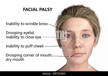 Bell's Parsy, eine einseitige Gesichtslähmung, Computerdarstellung. Die Erkrankung ist auf eine Entzündung des Nervus facialis zurückzuführen. Es verursacht eine gesichtsbehandlung Stockfoto