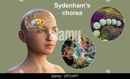 Chorea Sydenham, eine Autoimmunerkrankung, die aus einer Streptokokkeninfektion resultiert, Bildung von anti-neuronalen Antikörpern, die die Basalganglien des Gehirns schädigen Stockfoto